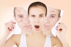 Benefits of Chemical Peeling You Didn’t Know About