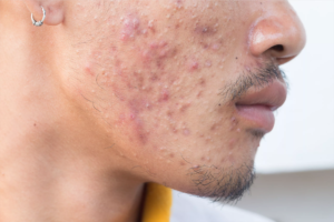Does Acne Scar Treatment Work for Men Too