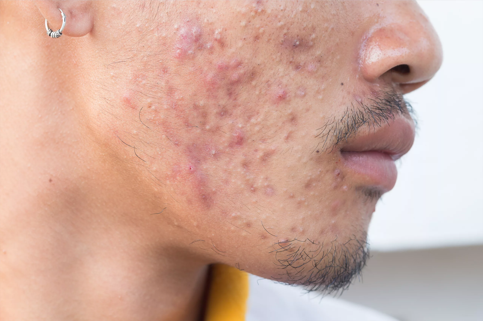 Does Acne Scar Treatment Work for Men Too