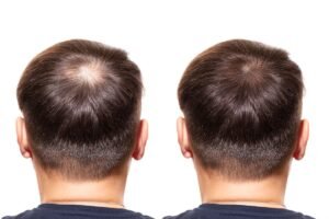 Hair-Transplants-Methods