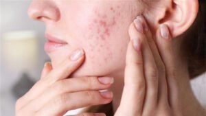 How Does Acne Treatment Affect Skin Texture?