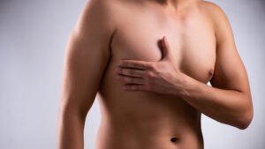 Is Liposuction Part of Gynecomastia Surgery?