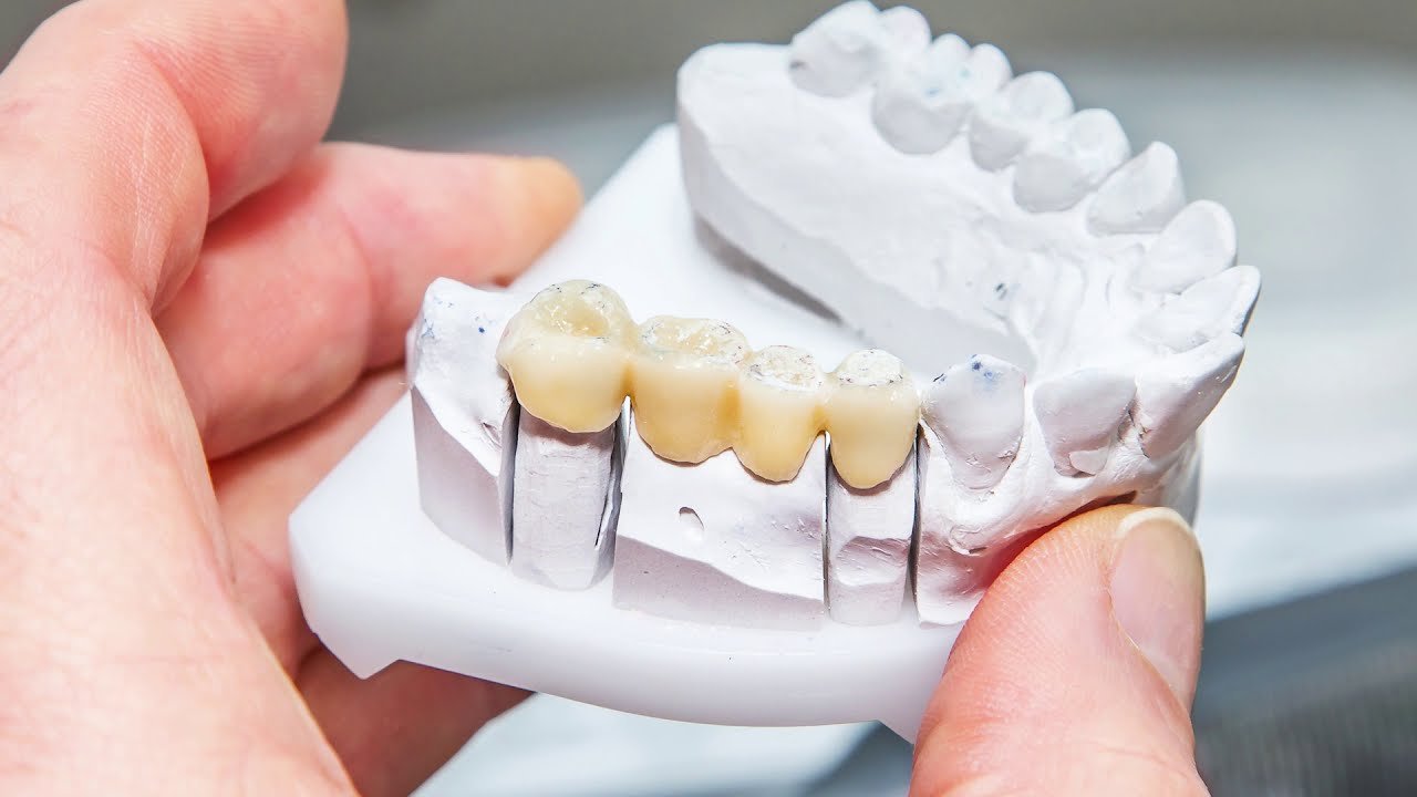 Long-Term Success of Dental Implants Explained