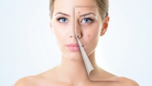 Natural Acne Scar Treatment Alternatives That Work