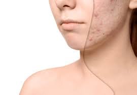 Scar Removal Treatments for Different Skin Tones