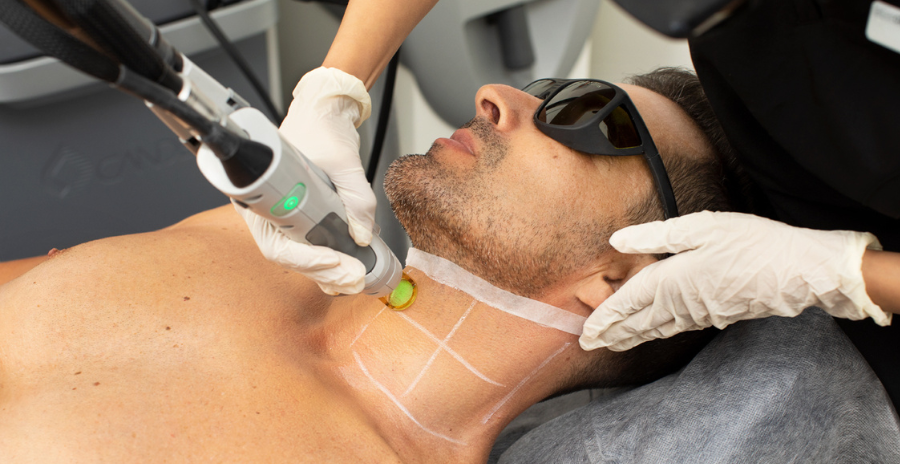 What Are the Hidden Costs of Full Body Laser Hair Removal?