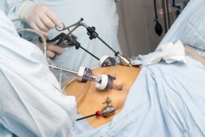 What Doctors Don’t Always Tell About Bariatric Surgery