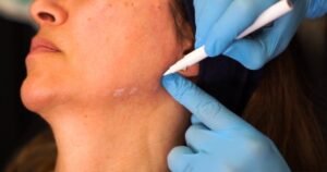 What Makes a Good Candidate for Jawline Filler?