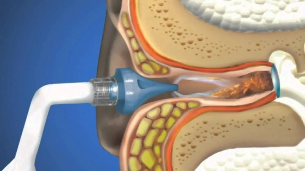Ear Wax Removal