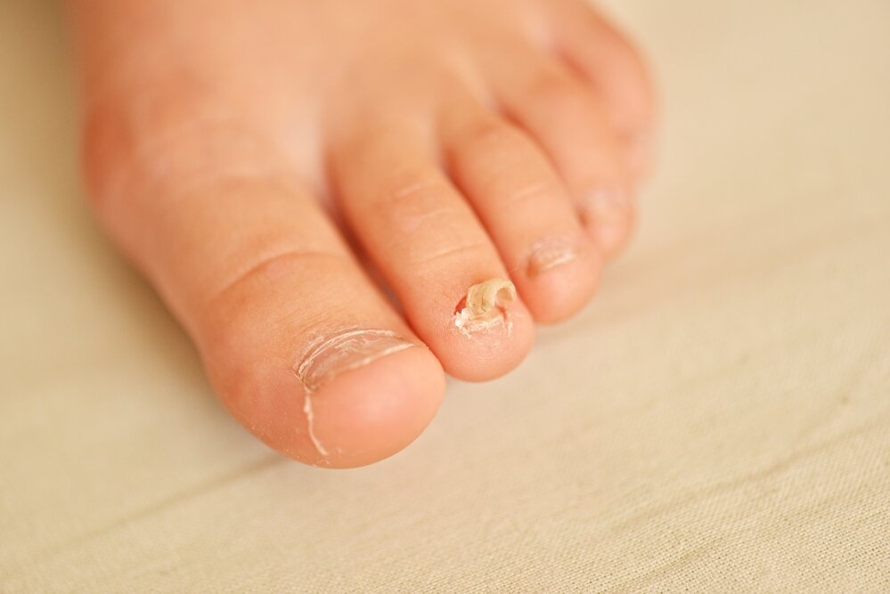 Oral and Surgical Options for Fungal Nails in Edinburgh
