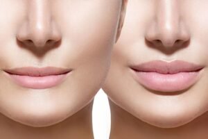 Benefits of Cheek Augmentation for Aging Skin