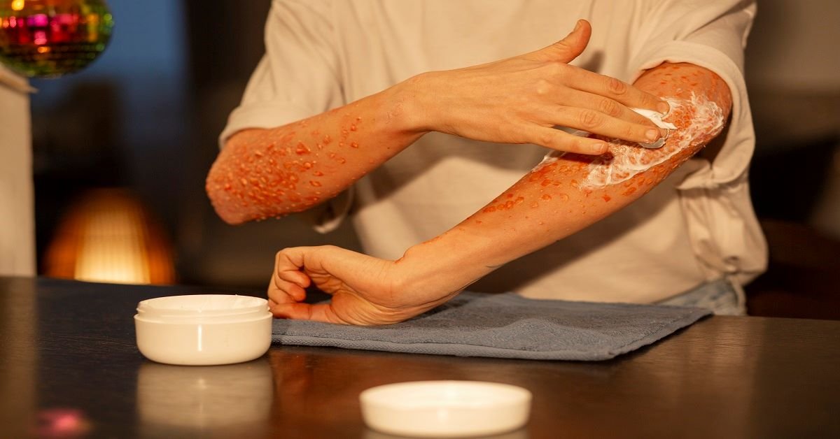 Benefits of reconstructive burn surgery today