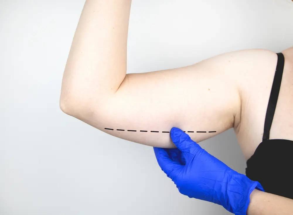 Brachioplasty vs Exercise: What Works Best