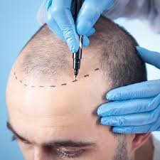 How Painful Is a Hair Transplant in Dubai?