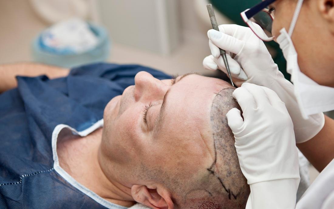 Does Hair Replacement Work for Pattern Baldness?