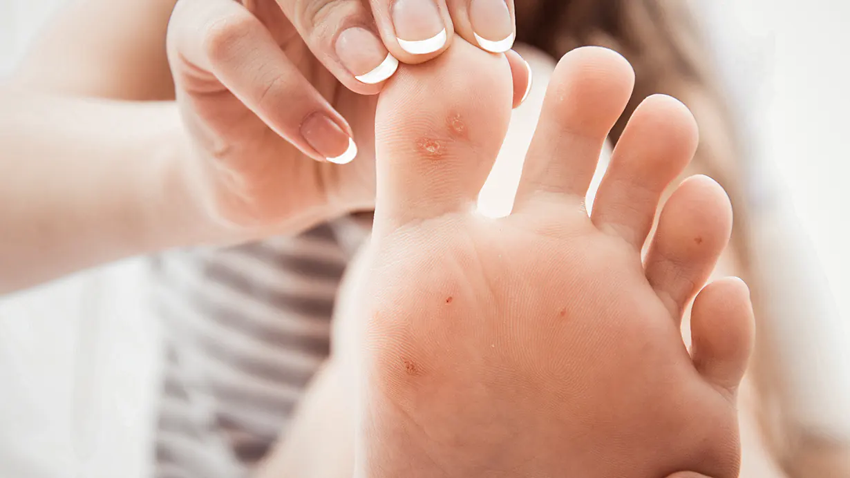 How Can You Remove Warts at Home Safely