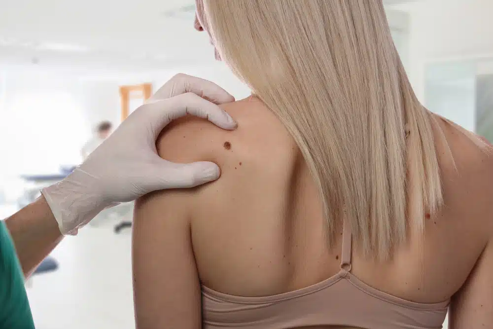 How Often Do You Need Mole Removal Treatment?