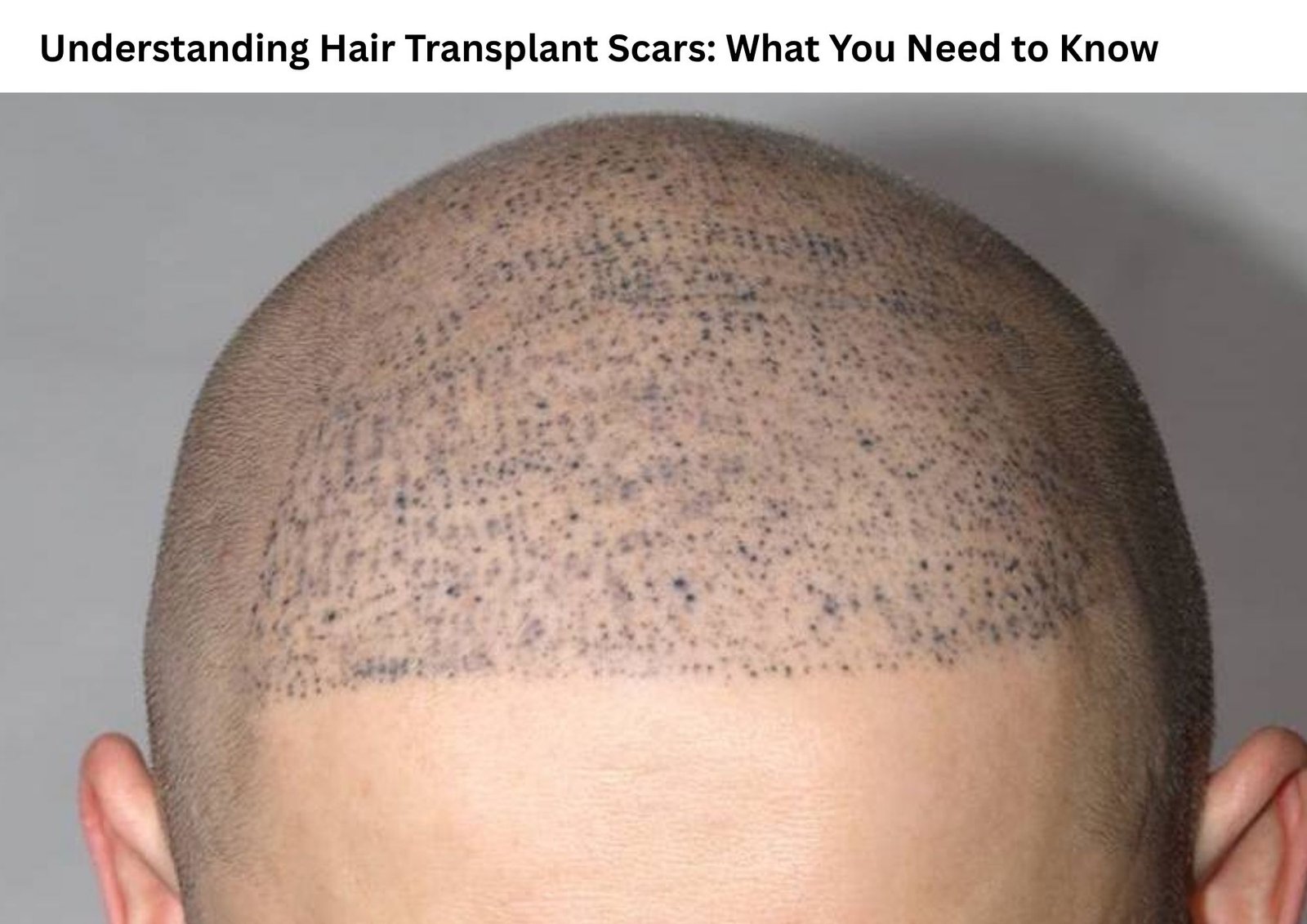 Understanding Hair Transplant Scars: What You Need to Know