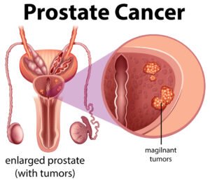 Affordable and Advanced: A Guide to Prostate Cancer Treatment in India