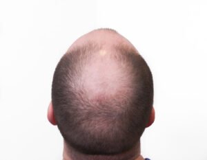Does Scalp Micropigmentation Require Maintenance