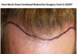 How Much Does Forehead Reduction Surgery Cost in 2025?