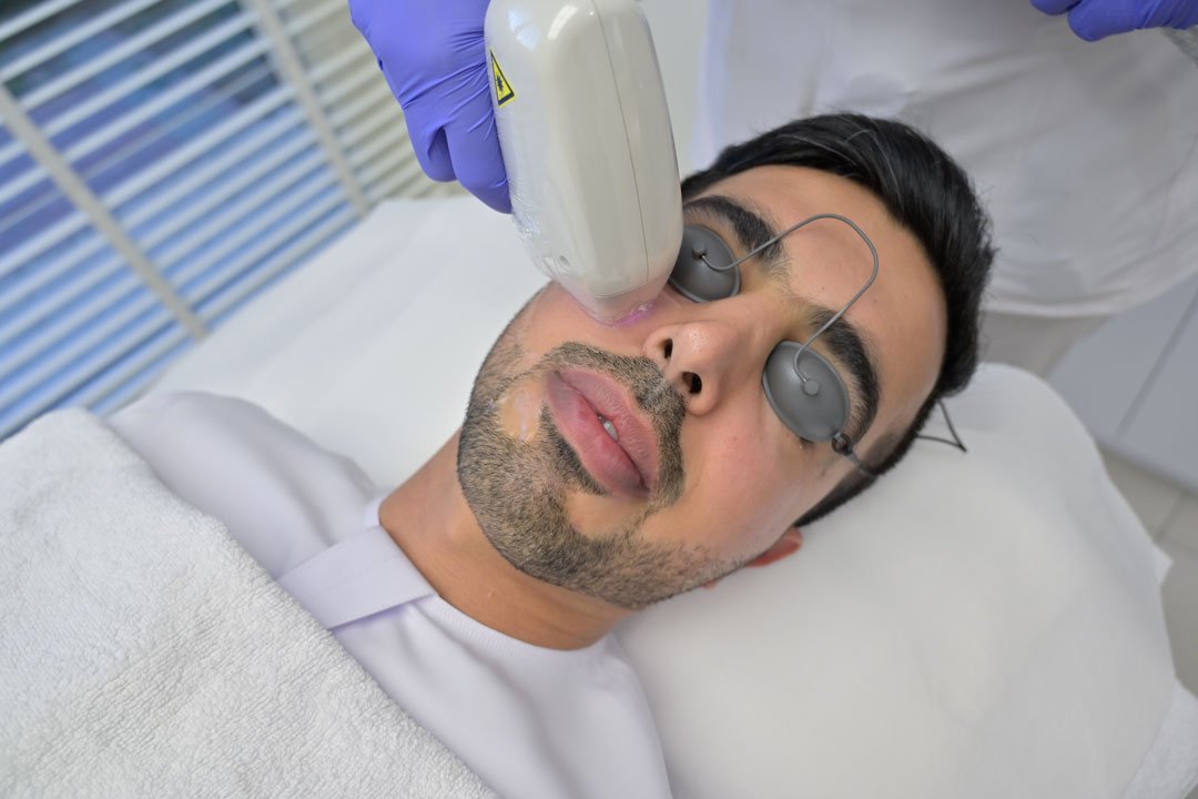 How Safe Is Beard Laser Hair Removal for Skin?