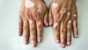 Is Laser Vitiligo Treatment a Good Option?