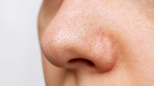 Large pores treatment and hydration tips