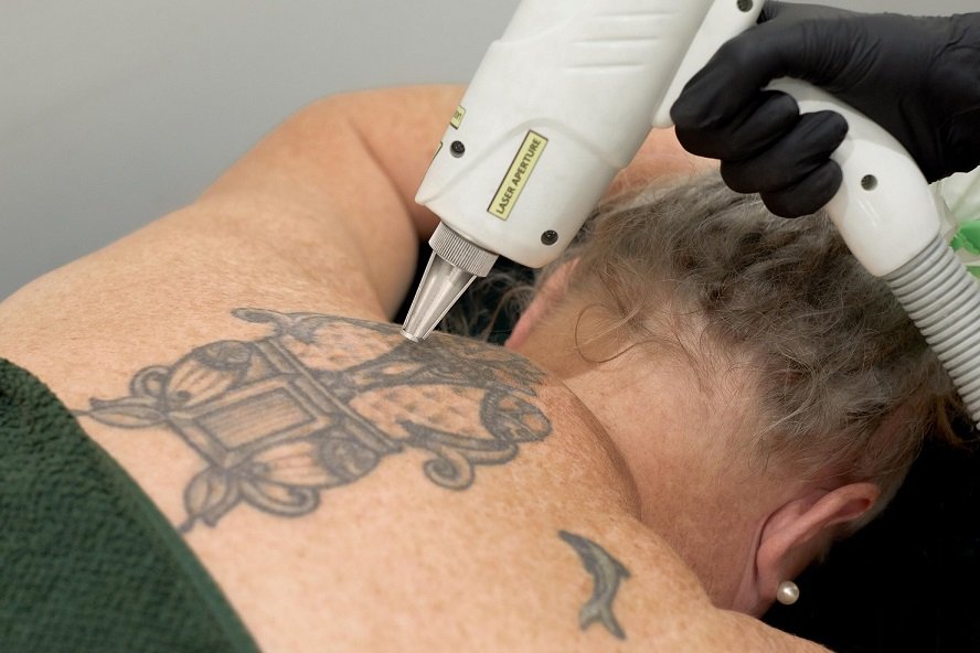 Laser Tattoo Removal: Is It Right for You