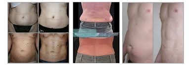 Liposuction FAT REMOVAL TREATMENT
