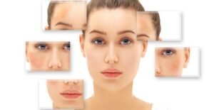 Melasma Treatment: For Long-Term Skin Clarity