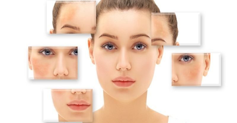 Melasma Treatment: For Long-Term Skin Clarity