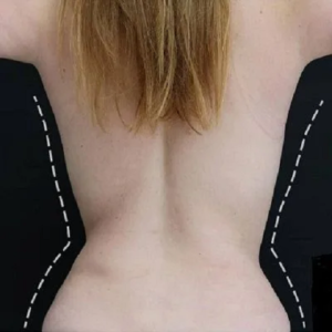 Reshape Your Life with 360 Liposuction Body Plan
