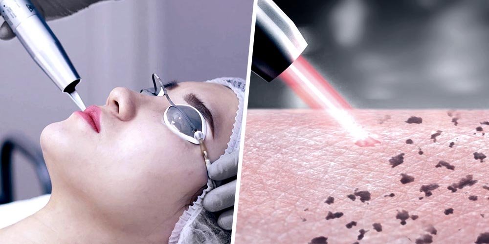 Scar Laser Treatment for Chest and Back Scars