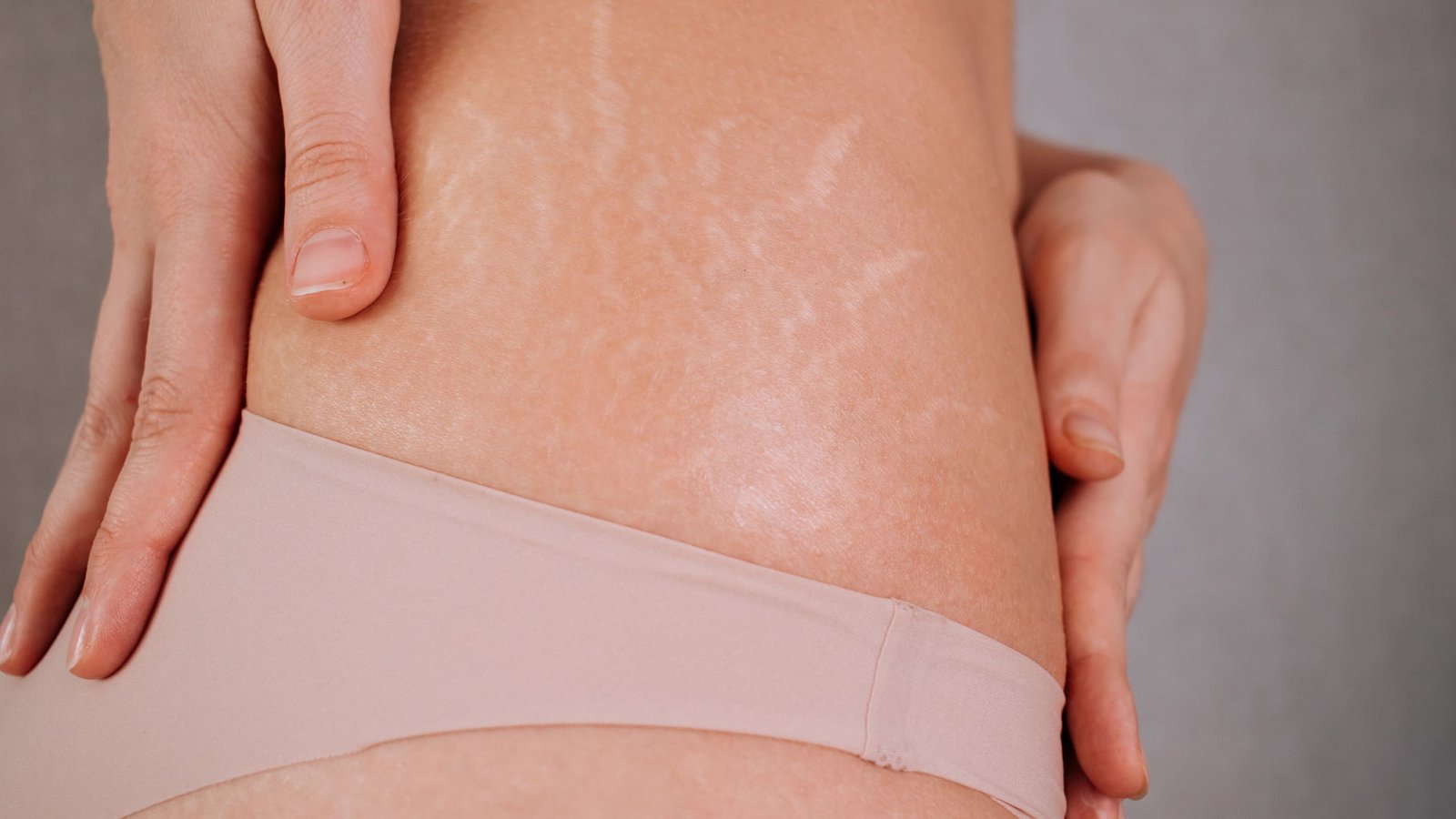 Stretch Marks Removal: What’s Best for Teen Skin