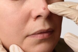 Warts Removal Surgery Explained in Simple Steps