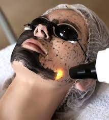 What to Expect Before and After a Laser Carbon Peel Session