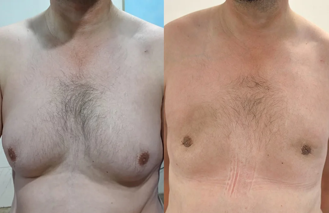 gynecomastia surgery in islamabad