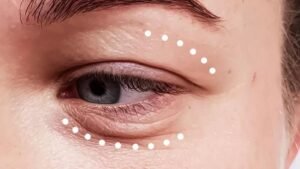 Blepharoplasty Dubai