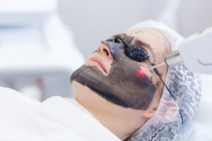 Can Laser Carbon Peel Remove Facial Hair?