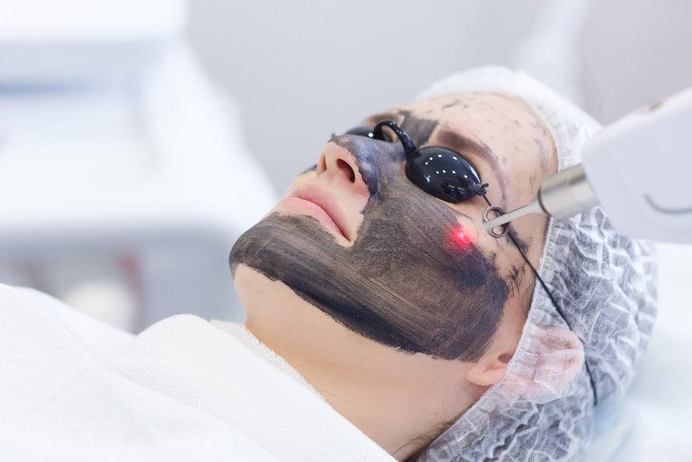Can Laser Carbon Peel Remove Facial Hair?