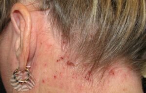 Can a dermatologist treat scalp eczema naturally
