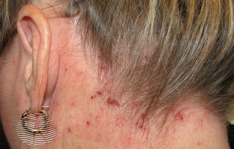 Can a dermatologist treat scalp eczema naturally