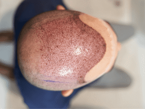 Does Hair Transplant Cost Depend on Baldness Level?