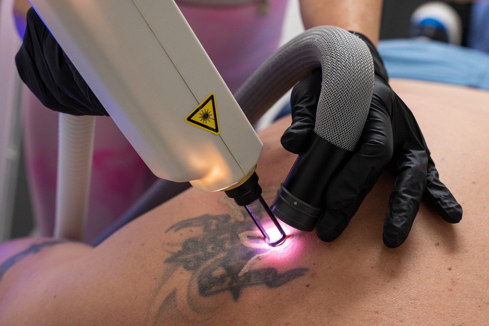 Does Laser Tattoo Removal Effectiveness Depend on Color