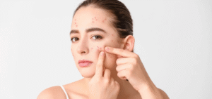 Does Pimples Treatment Improve Skin Confidence