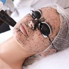 Does Spectra Laser Carbon Peel Tighten Pores and Brighten Skin