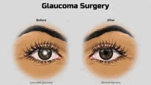 Signs You Need the Best Glaucoma Care in Phagwara