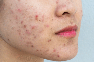 How Acne Treatment Restores Skin Confidence