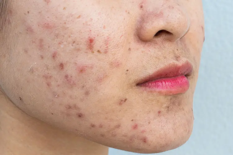 How Acne Treatment Restores Skin Confidence